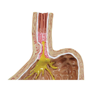 4 bucăţi Gerd - (Boala de reflux gastro-esofagian)