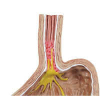 Load image into Gallery viewer, 4 bucăţi Gerd - (Boala de reflux gastro-esofagian)