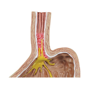 4 bucăţi Gerd - (Boala de reflux gastro-esofagian)