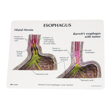 Load image into Gallery viewer, 4 bucăţi Gerd - (Boala de reflux gastro-esofagian)