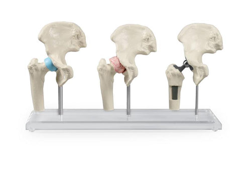 Model implant de şold