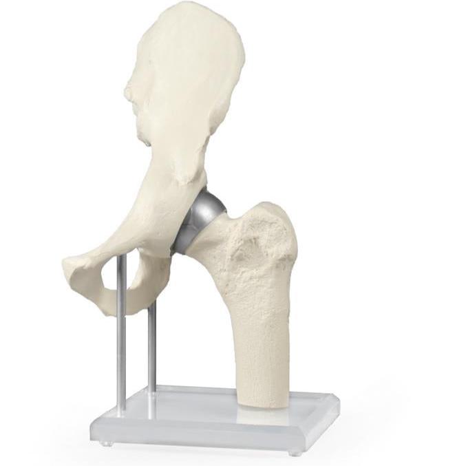 Model - Articulaţia şoldului cu implant resurfacing