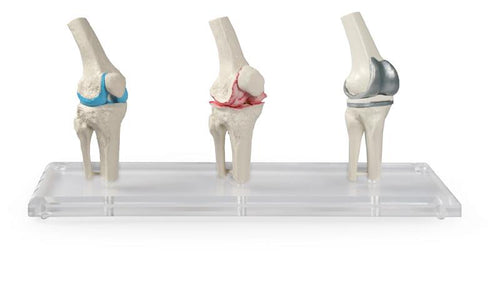 Model implant genunchi