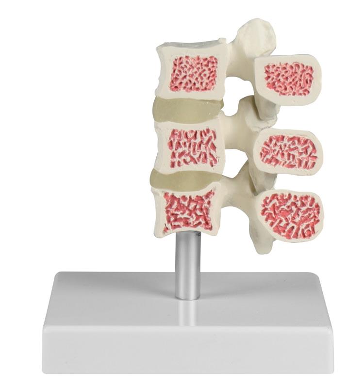 Model de vertebre cu osteoporoză, 3 vertebre