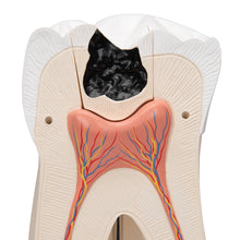 Load image into Gallery viewer, Model de dinte uman molar gigant cu cavităţi dentare, de 15 ori mărimea naturală, în 6 părţi - 3B Smart Anatomy