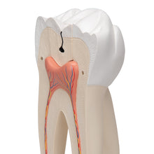 Load image into Gallery viewer, Model de dinte uman molar gigant cu cavităţi dentare, de 15 ori mărimea naturală, în 6 părţi - 3B Smart Anatomy