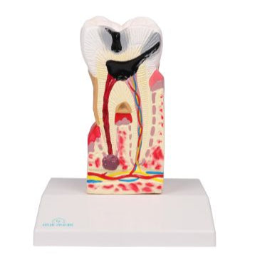 Model de carii dentare, de 10 ori dimensiunea naturală