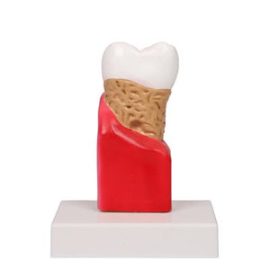 Model de carii dentare, de 10 ori dimensiunea naturală