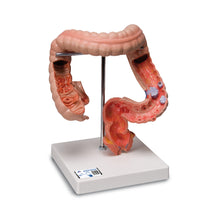 Load image into Gallery viewer, Modelul bolilor intestinale - 3B Smart Anatomy