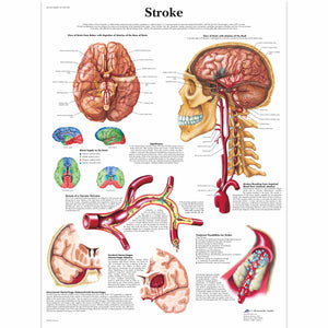 Poster " Accident vascular cerebral" 3bScientific