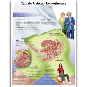 Poster "Incontinenţă urinară feminină"