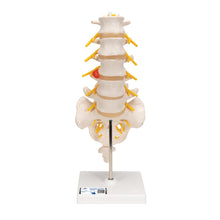 Load image into Gallery viewer, Model de coloană vertebrală lombară umană cu disc intervertebral prolapsat dorso-lateral - 3B Smart Anatomy