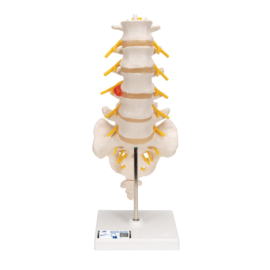 Model de coloană vertebrală lombară umană cu disc intervertebral prolapsat dorso-lateral - 3B Smart Anatomy