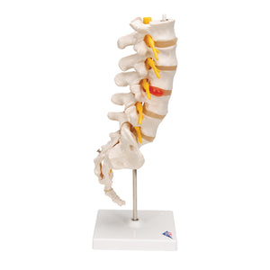 Model de coloană vertebrală lombară umană cu disc intervertebral prolapsat dorso-lateral - 3B Smart Anatomy