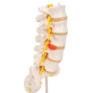 Model de coloană vertebrală lombară umană cu disc intervertebral prolapsat dorso-lateral - 3B Smart Anatomy