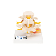 Load image into Gallery viewer, Model coloană vertebrală lombară  umană cu disc prolapsat intervertebral - 3B Smart Anatomy