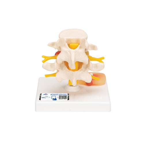 Model coloană vertebrală lombară  umană cu disc prolapsat intervertebral - 3B Smart Anatomy
