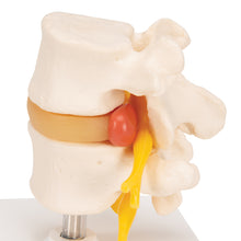 Load image into Gallery viewer, Model coloană vertebrală lombară  umană cu disc prolapsat intervertebral - 3B Smart Anatomy