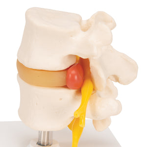 Model coloană vertebrală lombară  umană cu disc prolapsat intervertebral - 3B Smart Anatomy