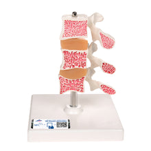 Load image into Gallery viewer, Model &quot;Deluxe&quot; de osteoporoză umană (3 vertebre cu discuri), detașabil pe suport - 3B Smart Anatomy