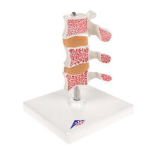 Load image into Gallery viewer, Model &quot;Deluxe&quot; de osteoporoză umană (3 vertebre cu discuri), detașabil pe suport - 3B Smart Anatomy