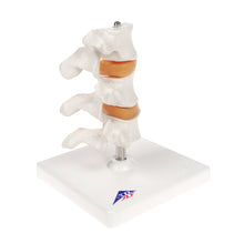 Load image into Gallery viewer, Model &quot;Deluxe&quot; de osteoporoză umană (3 vertebre cu discuri), detașabil pe suport - 3B Smart Anatomy