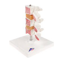 Load image into Gallery viewer, Model &quot;Deluxe&quot; de osteoporoză umană (3 vertebre cu discuri), detașabil pe suport - 3B Smart Anatomy
