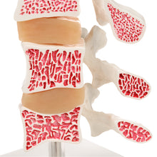 Load image into Gallery viewer, Model &quot;Deluxe&quot; de osteoporoză umană (3 vertebre cu discuri), detașabil pe suport - 3B Smart Anatomy
