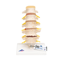 Load image into Gallery viewer, Etapele Prolapsului Discului și Degenerescenta Vertebrală - 3B Smart Anatomy