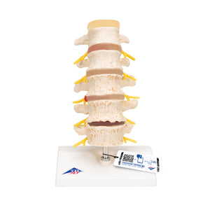 Etapele Prolapsului Discului și Degenerescenta Vertebrală - 3B Smart Anatomy