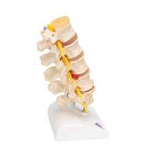 Load image into Gallery viewer, Etapele Prolapsului Discului și Degenerescenta Vertebrală - 3B Smart Anatomy