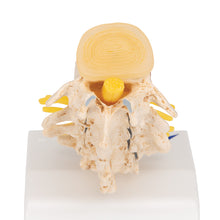 Load image into Gallery viewer, Etapele Prolapsului Discului și Degenerescenta Vertebrală - 3B Smart Anatomy