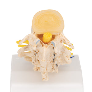 Etapele Prolapsului Discului și Degenerescenta Vertebrală - 3B Smart Anatomy