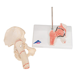 Model de fractură femurală umană şi osteoartrita de şold - 3B Smart Anatomy