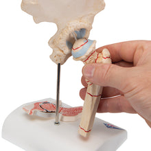 Load image into Gallery viewer, Model de fractură femurală umană şi osteoartrita de şold - 3B Smart Anatomy