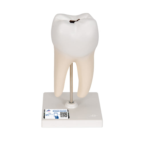 Molar inferior cu rădăcină dublă cu cavităţi , 2 părţi - 3B Smart Anatomy