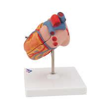 Load image into Gallery viewer, Model clasic de inimă umană cu hipertrofie ventriculară stângă (LVH), 2 părţi - 3B Smart Anatomy