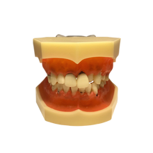 Load image into Gallery viewer, Model boală parodontală fără dinţi detaşabili - 4003
