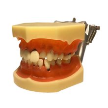 Load image into Gallery viewer, Model boală parodontală fără dinţi detaşabili - 4003