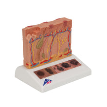 Load image into Gallery viewer, Model de cancer de piele cu 5 stadii, mărit de 8 ori - 3B Smart Anatomy