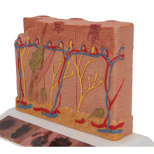 Load image into Gallery viewer, Model de cancer de piele cu 5 stadii, mărit de 8 ori - 3B Smart Anatomy