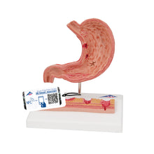 Load image into Gallery viewer, Model de secţiune de stomac uman cu ulcere - 3B Smart Anatomy
