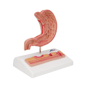 Model de secţiune de stomac uman cu ulcere - 3B Smart Anatomy