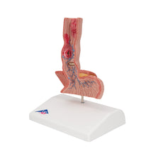 Load image into Gallery viewer, Model de boli ale esofagului uman în mărime naturală - 3B Smart Anatomy