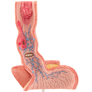 Model de boli ale esofagului uman în mărime naturală - 3B Smart Anatomy