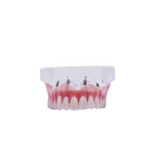 Load image into Gallery viewer, Model transparent cu proteză maxilară detaşabilă pe implanturi