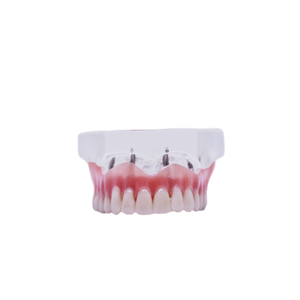 Model transparent cu proteză maxilară detaşabilă pe implanturi