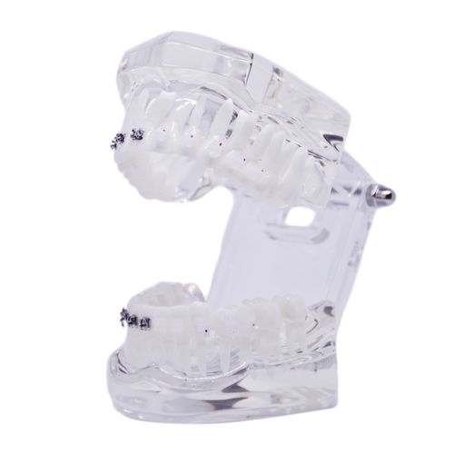 Model ortodontic transparent cu brackeţi metalici şi din ceramică