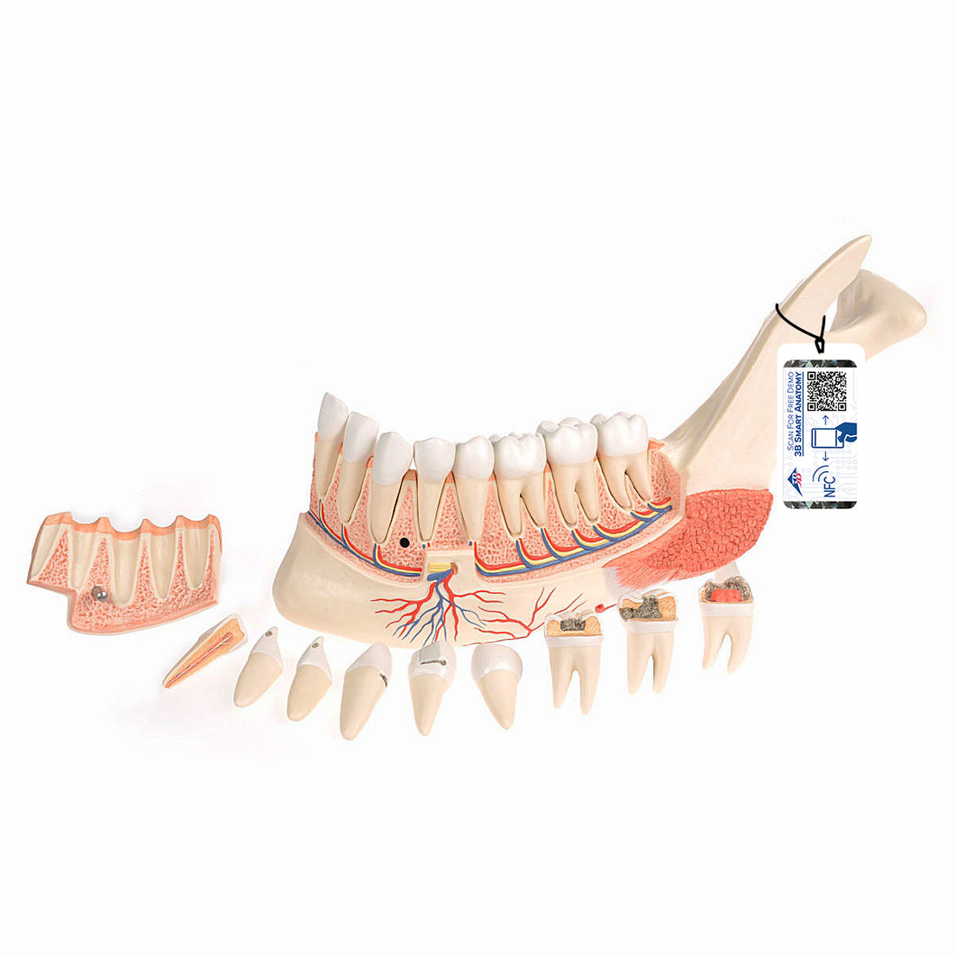Model  falcă inferioară (jumătatea stângă) cu dinţi, nervi, vase şi glande bolnave, 19 părţi - 3B Smart Anatomy