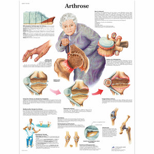Artroza - 3B Smart Anatomy